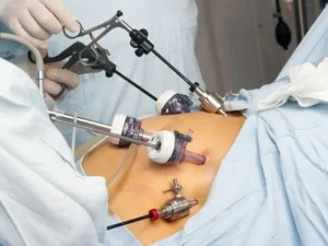 جراحی میومکتومی با لاپاراسکوپی