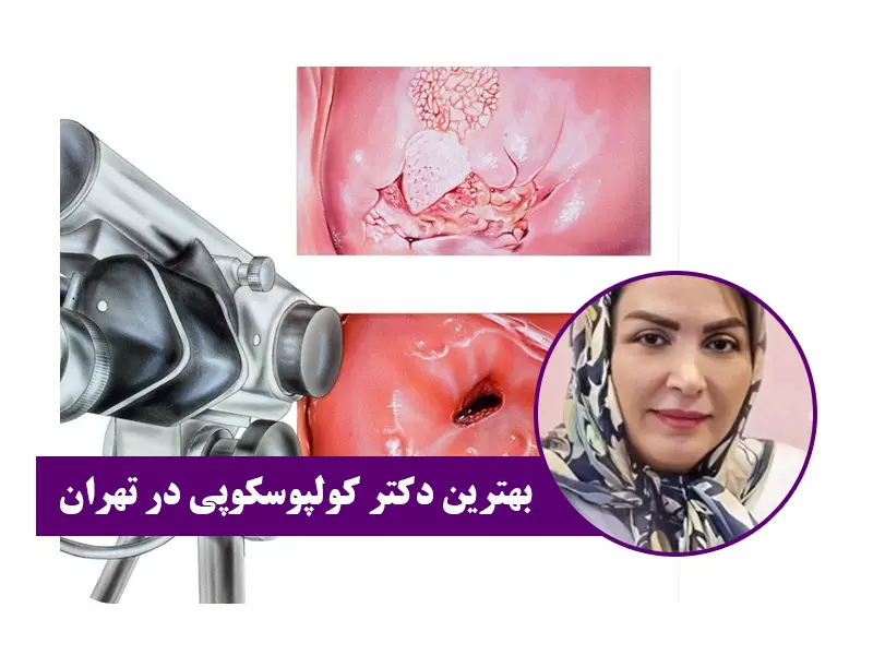 بهترین دکتر کولپوسکوپی در تهران