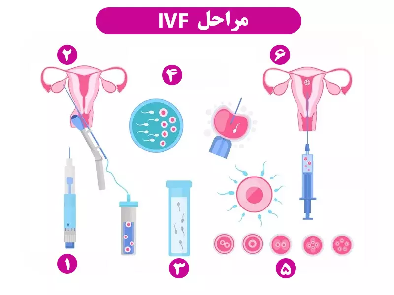 بارداری با آندومتریوز - IVF
