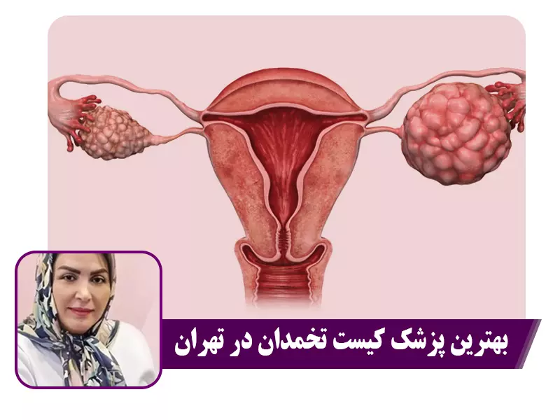 بهترین پزشک کیست تخمدان در تهران - 1